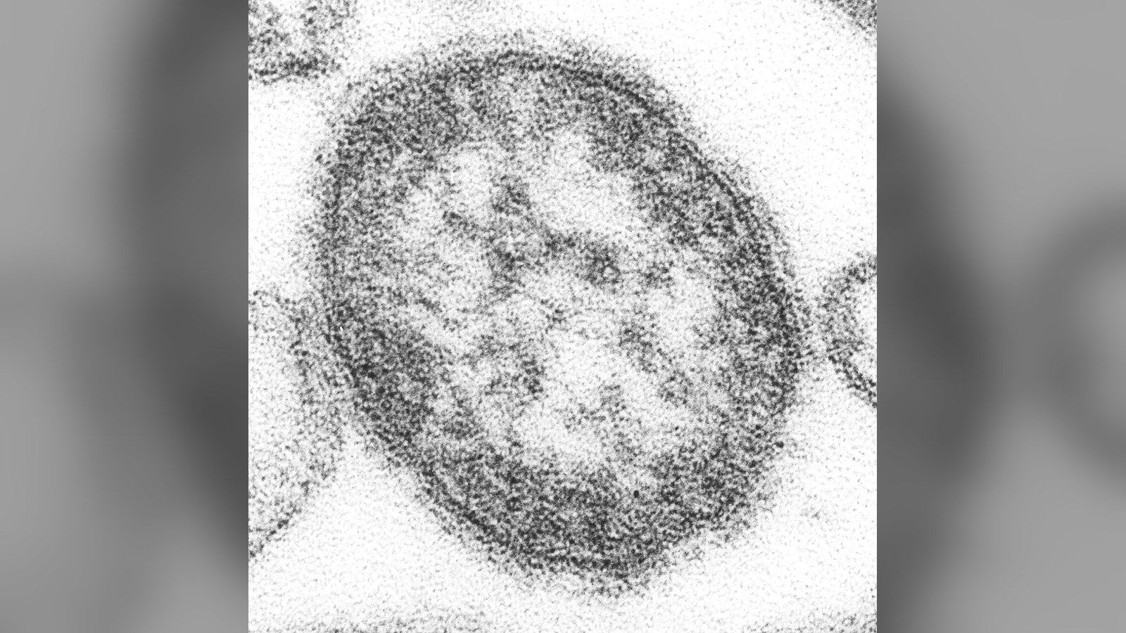 Rougeole : la Pennsylvanie enregistre un sixième décès, une femme non vaccinée de 39 ans